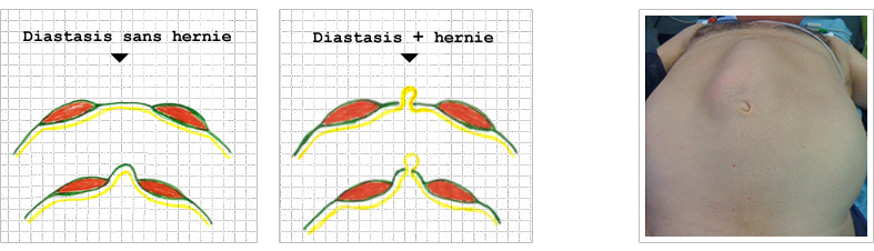 Diastasie, hernie ombilicale