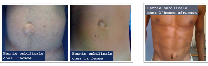 Hernie ombilicale, traitement hernies par le docteur Reboul